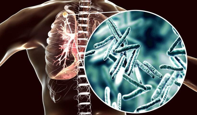 Tuberculosis