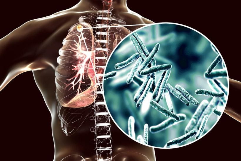Tuberculosis