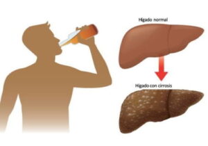 Hepatitis Alcohólica