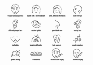 Características del Sindrome Treacher Collins
